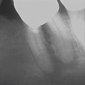 Röntgenbild eines entzündeten Backenzahns