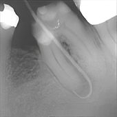 Röntgenbild einer Zahnfistel