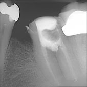 Röntgenbild eines Zahnes nach Behandlung