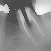 Röntgenbild einer Hemisektion