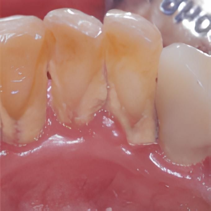 Zähne vor der Prophylaxebehandlung