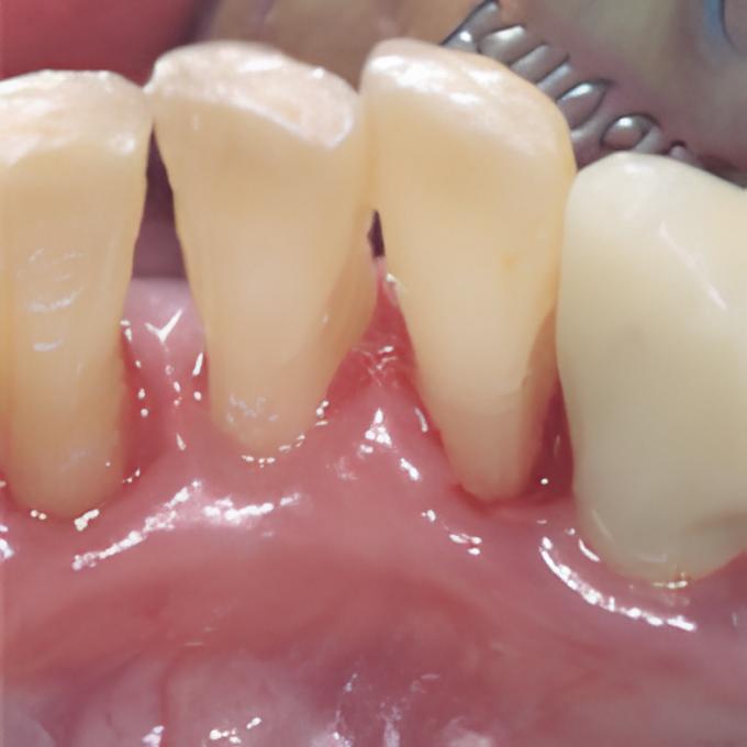 Zähne nach der Prophylaxebehandlung